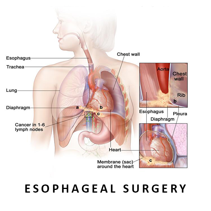 Esophageal Surgery in Ahmedabad, Gujarat